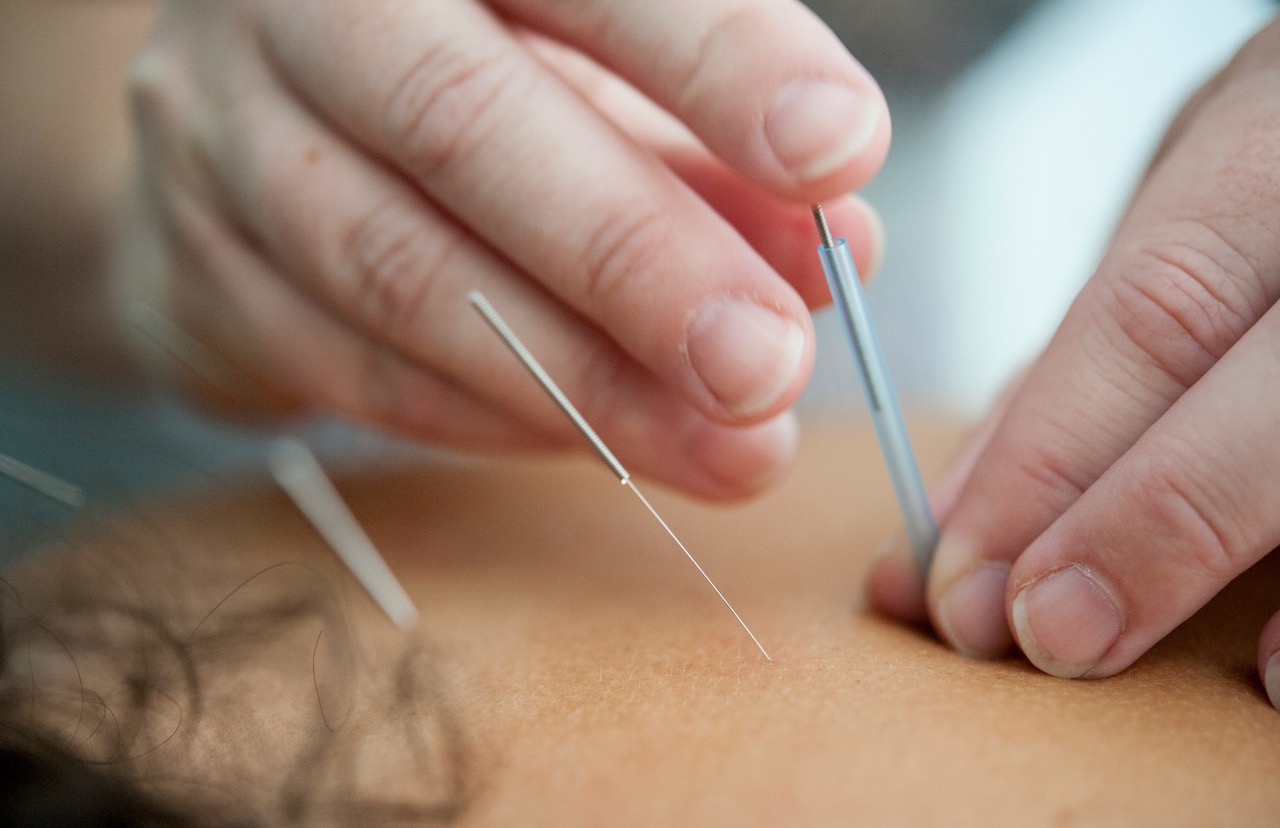 Acupuncture at LiveWellSLO in San Luis Obispo